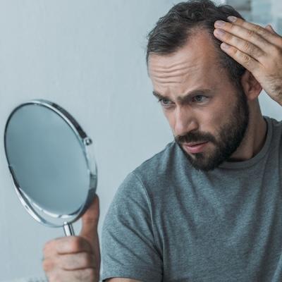 Mann betrachtet seinen Haaransatz im Spiegel, symbolisch für Haarausfall und medizinische Labordiagnostik zur Analyse von Hormonwerten, genetischen Faktoren und Stoffwechselparametern in der Laborambulanz.